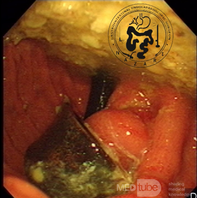 Erozja opaski żołądka - obraz endoskopowy