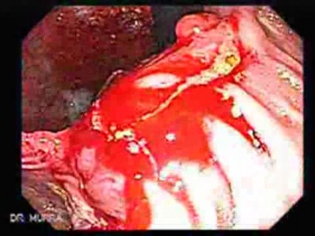 Nawrotowy rak żołądka po resekcji żołądka typu Billroth II (1 z 6)
