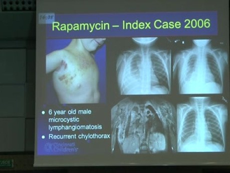 Skomplikowane anomalie naczyniowe – rosnąca rola farmakoterapii