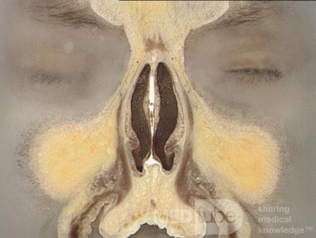 Anatomia nosa i zatok przynosowych w przekroju czołowym - przekrój 1