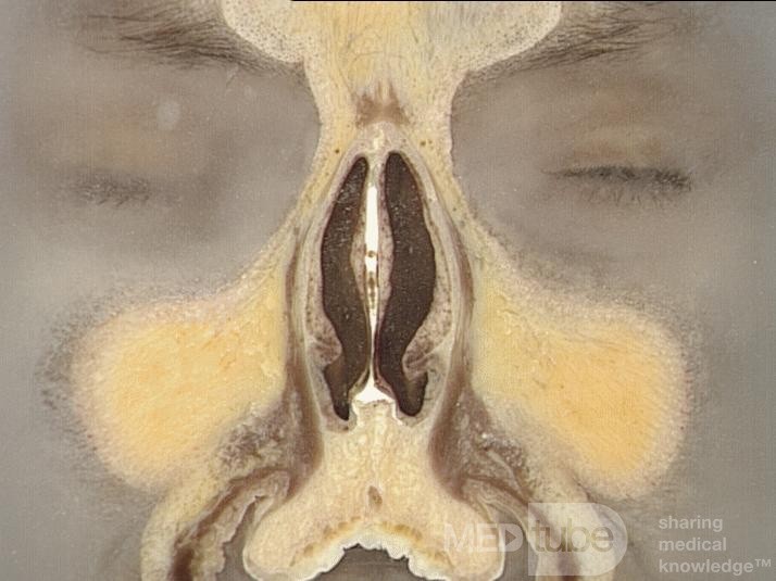 Anatomia nosa i zatok przynosowych w przekroju czołowym - przekrój 1