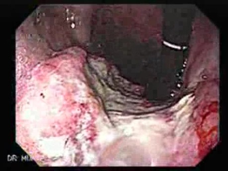 Gruczolakorak żołądka z żylakami - endoskopia (3 z 8)