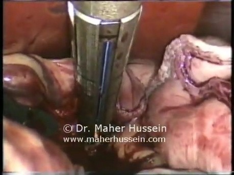 Gastrektomia laparoskopowa typu sleeve