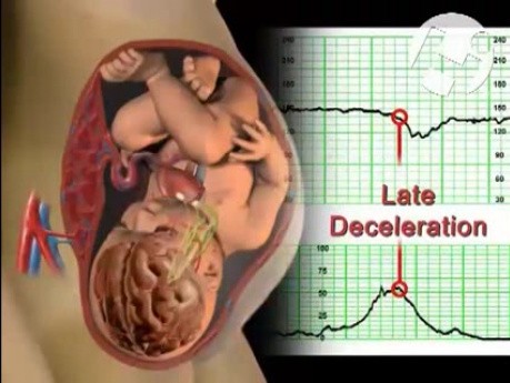 Płód - relacja mózg-serce