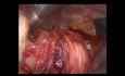 Operacja torakoskopowa mięśniaka gładkokomórkowego przełyku