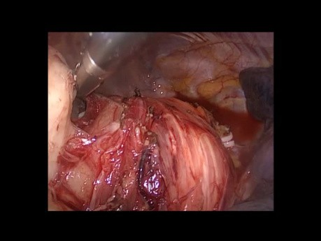 Operacja torakoskopowa mięśniaka gładkokomórkowego przełyku
