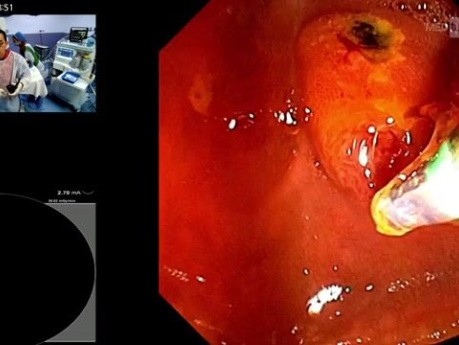 Endoskopowa cholangiopankreatografia wsteczna (ERCP) w ostrym ciężkim zapaleniu dróg żółciowych o etiologii bąblowcowej