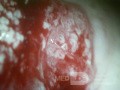 Rak gruczołowy szyjki macicy (Carcinoma Glandulare Colli Uteri)