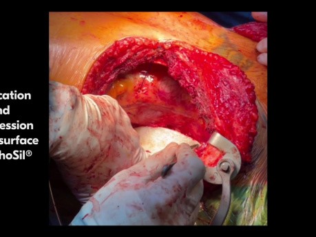 TachoSil for Sufficient Haemostasis and Sealing in a Double Lung Transplantation with V-V ECMO