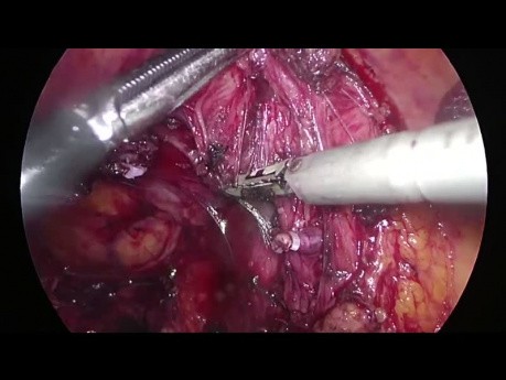 Całkowite wycięcie krezki okrężnicy (CME) metodą laparoskopową - hemikolektomia prawostronna