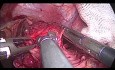 Laparoskopowa kardiomiotomia Hellera z fundoplikacją Dora