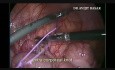 Laparoskopowa appendektomia w ciąży