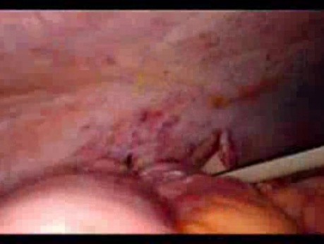 Perforacja okrężnicy z zapaleniem otrzewnej - laparoskopia (45 z 46)