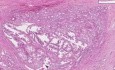 Prostata - Gruczolakorak Gleason (klasa 1) - Badanie histopatologiczne