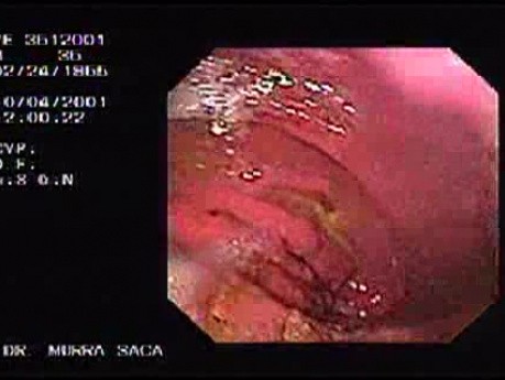Dziedziczny rozlany rak żołądka (HDGC) - endoskopia (2 z 4)