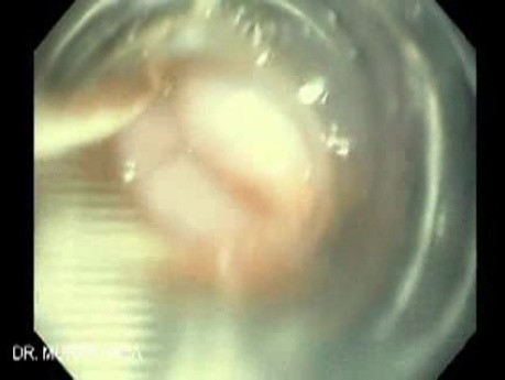 Krwawienie z górnej części przewodu pokarmowego z powodu żylaków przełyku - widok poprzez nieprzejrzysty cylinder