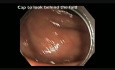 Ukryty polip w okrężnicy wstępującej zidentyfikowany przez endoskop z przezroczystą nasadką