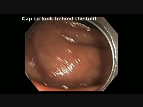Ukryty polip w okrężnicy wstępującej zidentyfikowany przez endoskop z przezroczystą nasadką