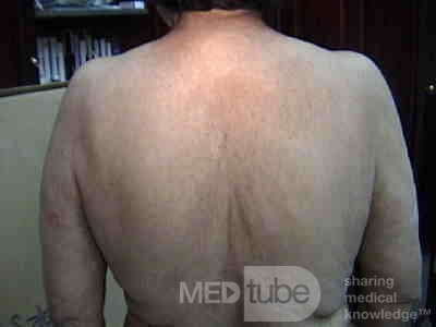 Acanthosis Nigricans - Ekstensywne rogowacenie ciemne z powodu raka okrężnicy (5 z 7)