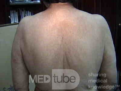 Acanthosis Nigricans - Ekstensywne rogowacenie ciemne z powodu raka okrężnicy (5 z 7)