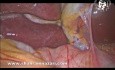 Anatomia bruzdy Rouviere'a widziana podczas cholecystektomii laparoskopowej