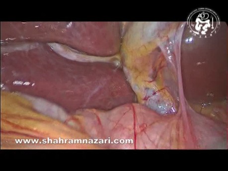 Anatomia bruzdy Rouviere'a widziana podczas cholecystektomii laparoskopowej