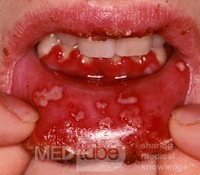 Opryszczkowe zapalenie jamy ustnej i dziąseł