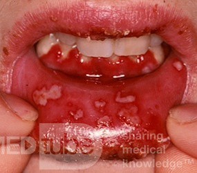 Opryszczkowe zapalenie jamy ustnej i dziąseł