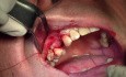 Wszczepienie implantu - #5 - technika szycia