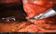 TAPP Peritoneal Rent Horizontal Mattress Purse String Closure Trick