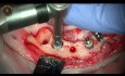 Ekstrakcja implantu oraz natychmiastowa implantacja połączona ze sterowaną regeneracją kości