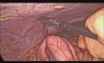 Laparoskopowa resekcja guza neuroendkorynnego jelita krętego