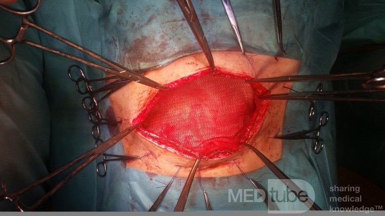 Etap implantacji siatki przepuklinowej dootrzewnowej sposobem Open – IPOM