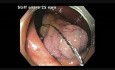 Komplikacje mukozektomii endoskopowej (EMR) - krwawienie z kątnicy - klip B