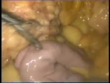 Konwersja laparoskopowej techniki Maison do bypassa żołądka sposobem Roux-en-Y