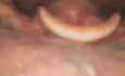 Laringoscopia