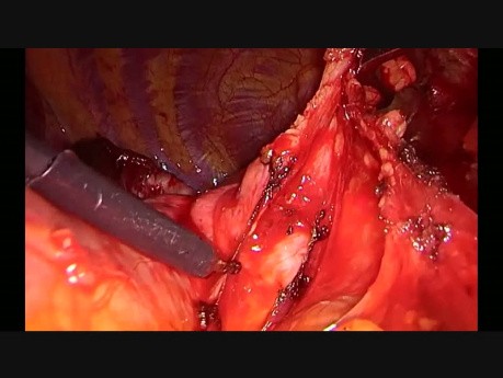 Wideotorakoskopowa prawa górna lobektomia z tymektomią z jednego cięcia podmostkowego
