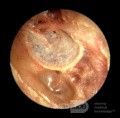 Rogowacenie obturacyjne powodujące erozję kości przewodu słuchowego zewnętrznego
