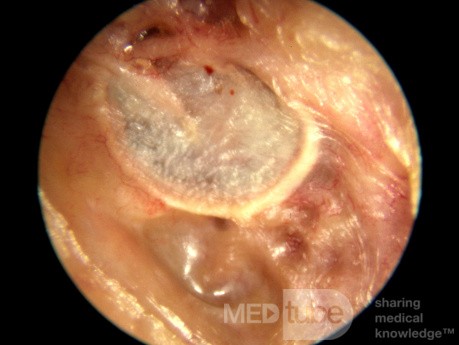Rogowacenie obturacyjne powodujące erozję kości przewodu słuchowego zewnętrznego