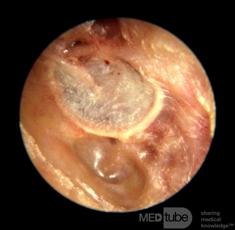 Rogowacenie obturacyjne powodujące erozję kości przewodu słuchowego zewnętrznego