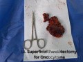 Onkocytoma lewej ślinianki przyusznej 