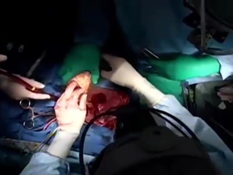 Transplantacja serca z wzmocnieniem anastomoz filcem teflonowym