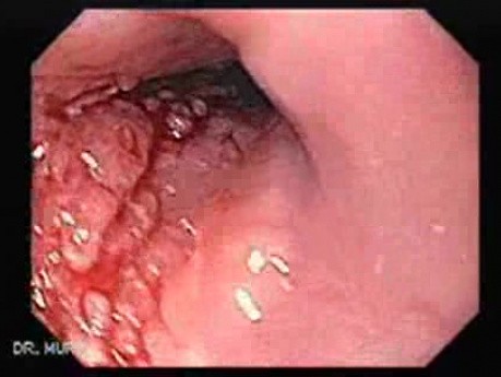 Rak płaskonabłonkowy przełyku - obraz błony śluzowej przełyku i guza