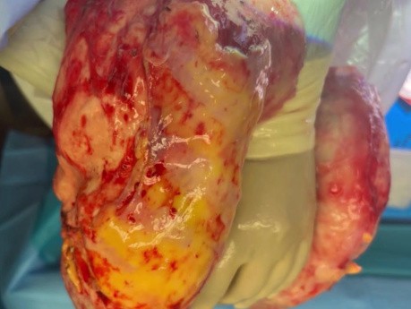 Nowe osiągnięcia w perfuzji płuc ex vivo i transplantacji płuc