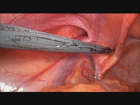 Anatomia okolicy pachwinowej w laparoskopii (rozwór mięśniowo-grzebieniowy)
