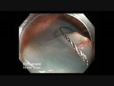 Kolonoskopia: rotacja endoskopu przed endoskopową resekcją śluzówkową płaskiej zmiany