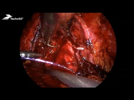 Rekonstrukcja i uszczelnienie układu moczowego z użyciem matrycy TachoSil w wybranych operacjach urologicznych