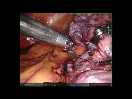 Segmentektomia anatomiczna — procedura z użyciem robota