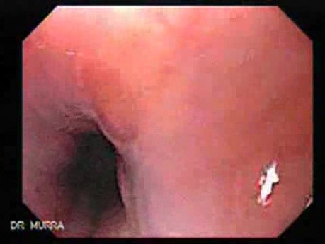Uchyłki środkowej części przełyku - heterotopowa śluzówka żołądka