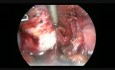 Laparoskopowa operacja obustronnego śluzowego gruczolaka torbielowatego